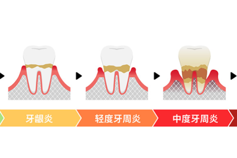 警惕！牙周病，终致牙齿松动、脱落