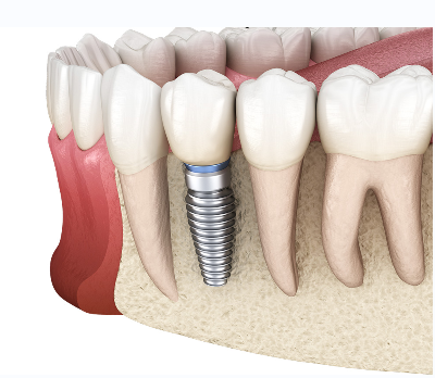种植牙流程是怎么样的？
