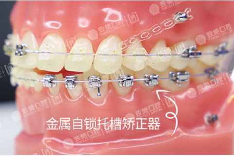 牙齿矫正有年龄限制吗？