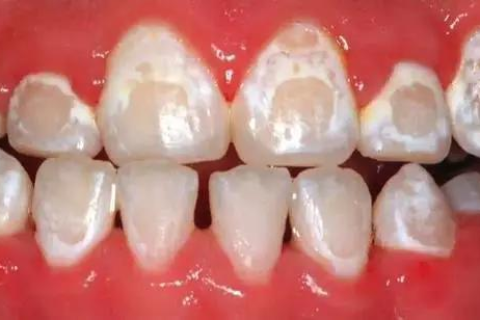 矫正期间牙齿出现白斑、白点是怎么回事？又该怎么办？