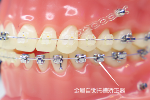 金属自锁托槽矫正器怎么样？