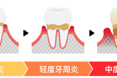 预防牙周病该怎么做？
