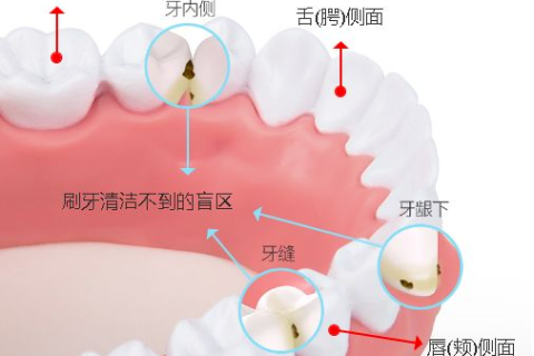 为什么要洗牙？