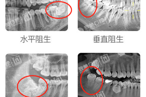 拔牙需要多少钱？