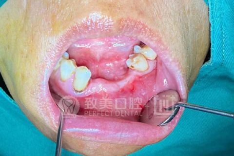 为什么有的人种牙需要植骨？植骨用的骨粉、骨膜又是什么？
