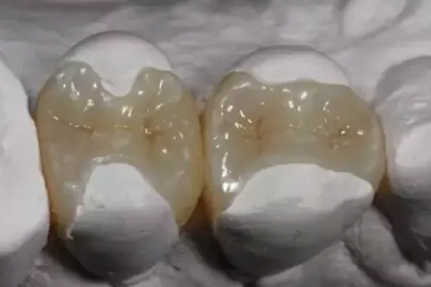 牙齿被蛀一大半怎么办？嵌体是个不错的选择