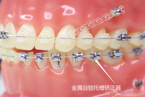 金属自锁托槽和非自锁托槽矫正器有啥区别？