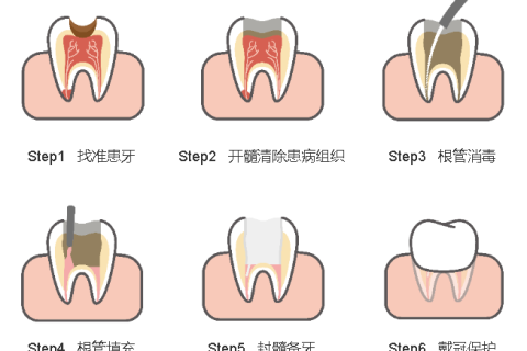 根管治疗后的牙齿，还能用多久？