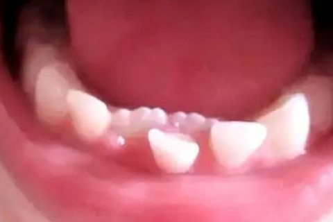 孩子乳牙出现哪些情况需要拔除？不拔会有什么危害？