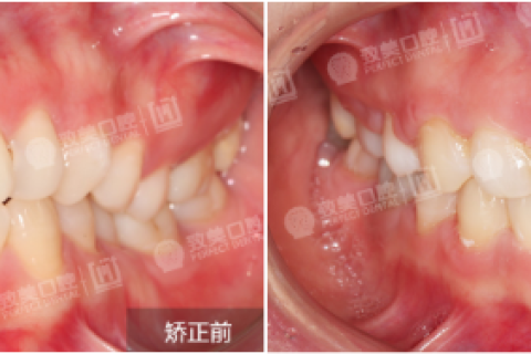 矫正牙齿有哪些改变？