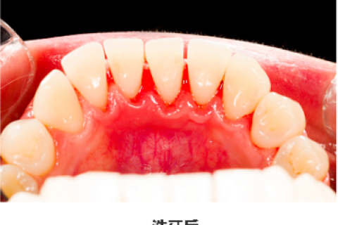 洗牙后牙缝变大是怎么回事？