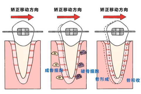 牙齿矫正有年龄限制吗？30岁了还能不能矫正？