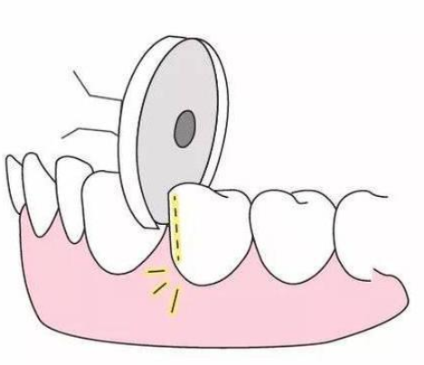 牙齿片切会不会导致牙齿敏感？